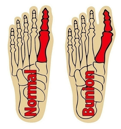 Correcteur orthopédique ajustable pour Hallux Valgus